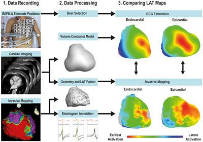 Comparing Non-invasive Inverse Electrocardiography With Invasive Endocardial and Epicardial Electroanatomical Mapping During Sinus Rhythm